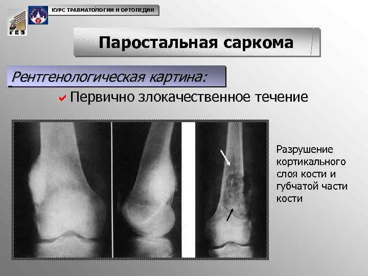 КУРС ТРАВМАТОЛОГИИ И ОРТОПЕДИИ Паростальная саркома Рентгенологическая картина: a. Первично злокачественное течение Разрушение кортикального