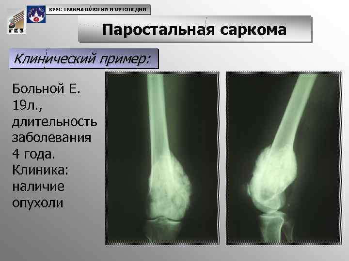 КУРС ТРАВМАТОЛОГИИ И ОРТОПЕДИИ Паростальная саркома Клинический пример: Больной Е. 19 л. , длительность