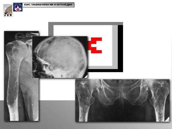 КУРС ТРАВМАТОЛОГИИ И ОРТОПЕДИИ Миелома 