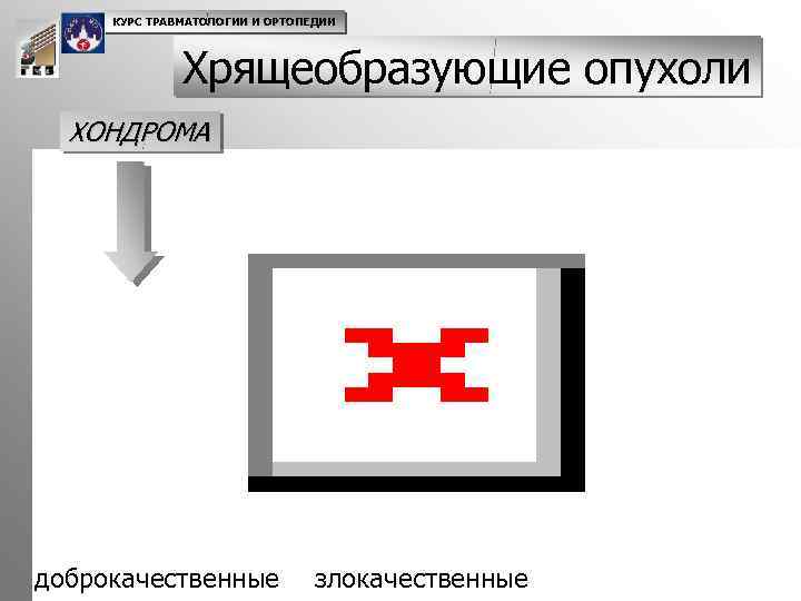 КУРС ТРАВМАТОЛОГИИ И ОРТОПЕДИИ Хрящеобразующие опухоли ХОНДРОМА доброкачественные злокачественные 