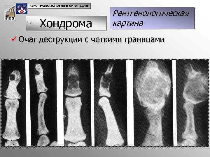 КУРС ТРАВМАТОЛОГИИ И ОРТОПЕДИИ Хондрома Рентгенологическая картина ü Очаг деструкции с четкими границами 