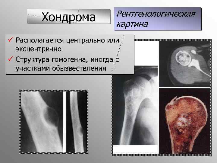 Хондрома Рентгенологическая картина ü Располагается центрально или эксцентрично ü Структура гомогенна, иногда с участками