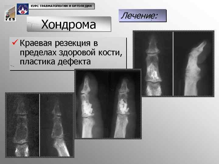 КУРС ТРАВМАТОЛОГИИ И ОРТОПЕДИИ Хондрома Лечение: ü Краевая резекция в пределах здоровой кости, пластика