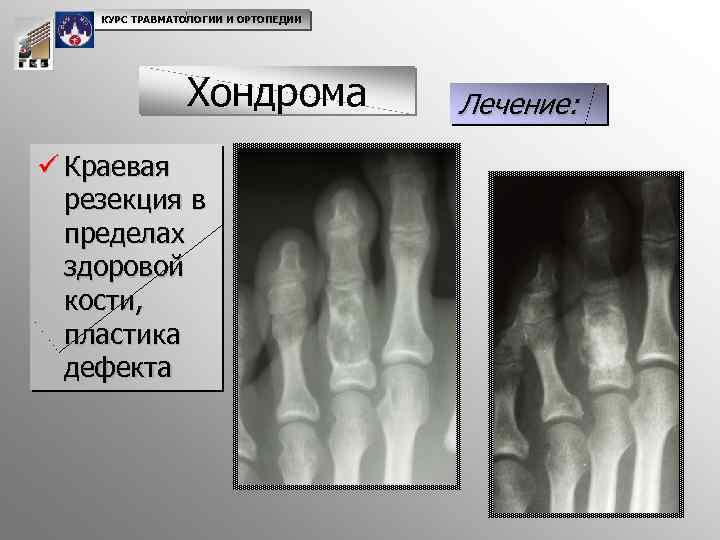 КУРС ТРАВМАТОЛОГИИ И ОРТОПЕДИИ Хондрома ü Краевая резекция в пределах здоровой кости, пластика дефекта