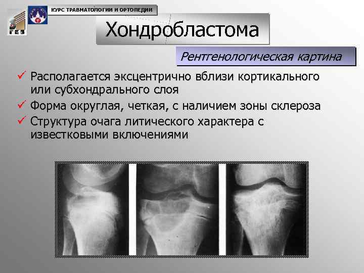 КУРС ТРАВМАТОЛОГИИ И ОРТОПЕДИИ Хондробластома Рентгенологическая картина ü Располагается эксцентрично вблизи кортикального или субхондрального