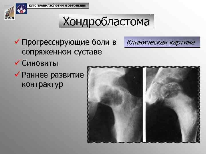 КУРС ТРАВМАТОЛОГИИ И ОРТОПЕДИИ Хондробластома ü Прогрессирующие боли в сопряженном суставе ü Синовиты ü