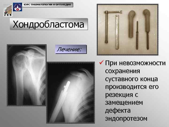 КУРС ТРАВМАТОЛОГИИ И ОРТОПЕДИИ Хондробластома Лечение: ü При невозможности сохранения суставного конца производится его