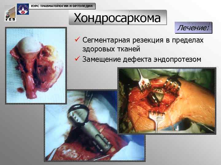 КУРС ТРАВМАТОЛОГИИ И ОРТОПЕДИИ Хондросаркома Лечение: ü Сегментарная резекция в пределах здоровых тканей ü