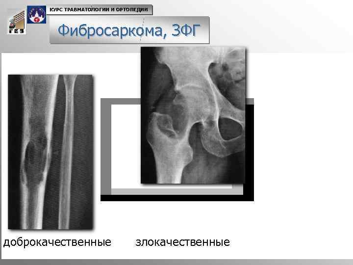 КУРС ТРАВМАТОЛОГИИ И ОРТОПЕДИИ Фибросаркома, ЗФГ доброкачественные злокачественные 