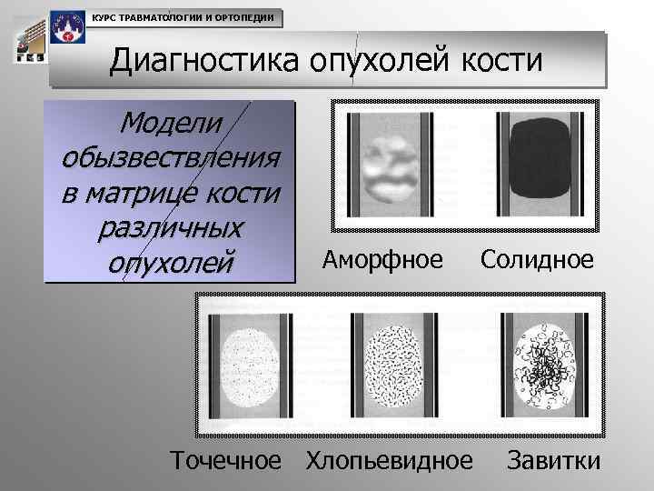 КУРС ТРАВМАТОЛОГИИ И ОРТОПЕДИИ Диагностика опухолей кости Модели обызвествления в матрице кости различных опухолей