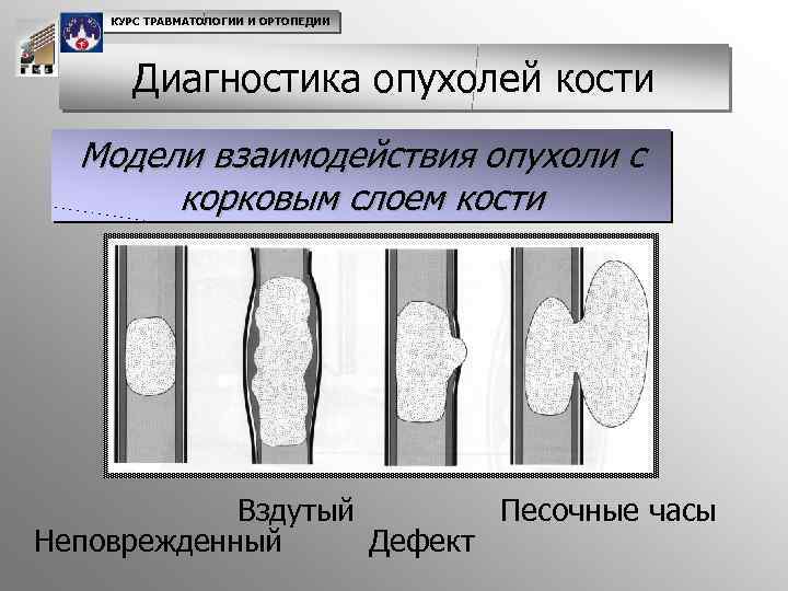 Диагностика опухоли кости