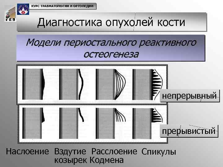 КУРС ТРАВМАТОЛОГИИ И ОРТОПЕДИИ Диагностика опухолей кости Модели периостального реактивного остеогенеза непрерывный прерывистый Наслоение