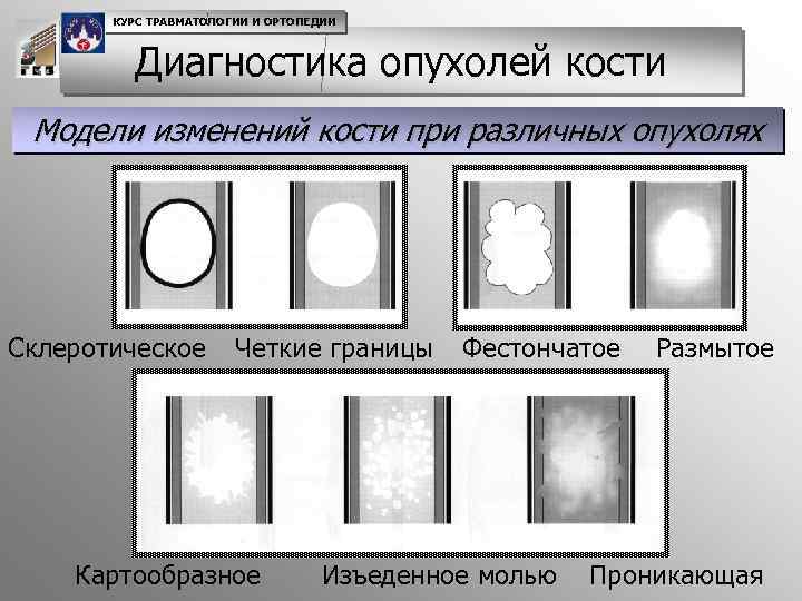 КУРС ТРАВМАТОЛОГИИ И ОРТОПЕДИИ Диагностика опухолей кости Модели изменений кости при различных опухолях Склеротическое