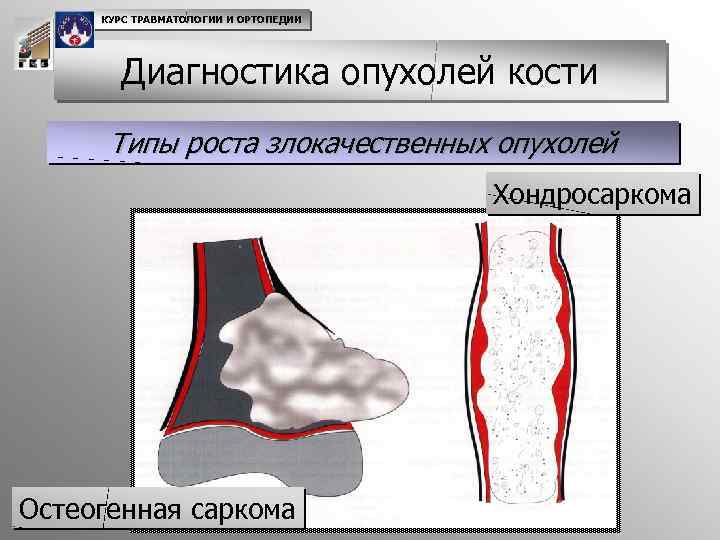 Диагностика опухоли кости. Хондросаркома кости кт. Новообразования костей схема. Злокачественная опухоль кости.