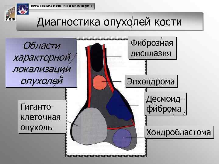 Для рентгенологической картины кистозной формы гигантоклеточной опухоли характерно