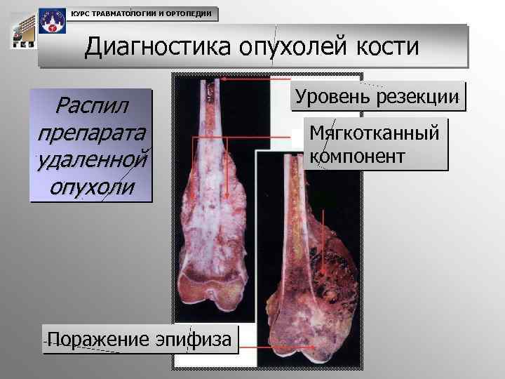 КУРС ТРАВМАТОЛОГИИ И ОРТОПЕДИИ Диагностика опухолей кости Распил препарата удаленной опухоли Поражение эпифиза Уровень