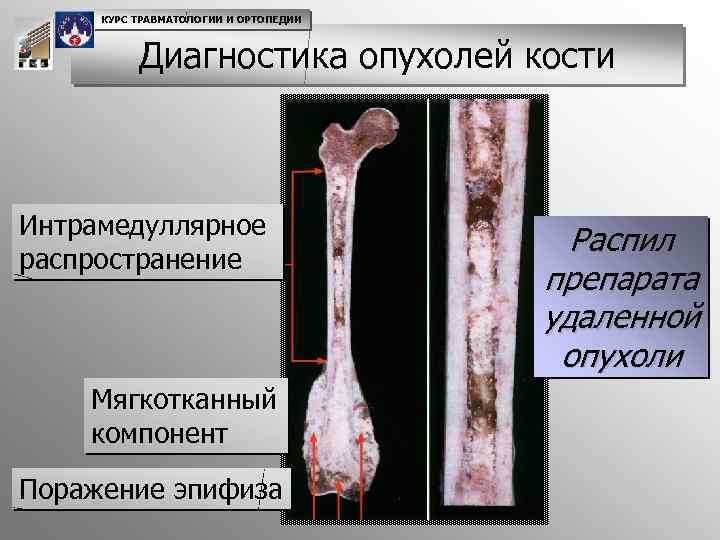 КУРС ТРАВМАТОЛОГИИ И ОРТОПЕДИИ Диагностика опухолей кости Интрамедуллярное распространение Мягкотканный компонент Поражение эпифиза Распил