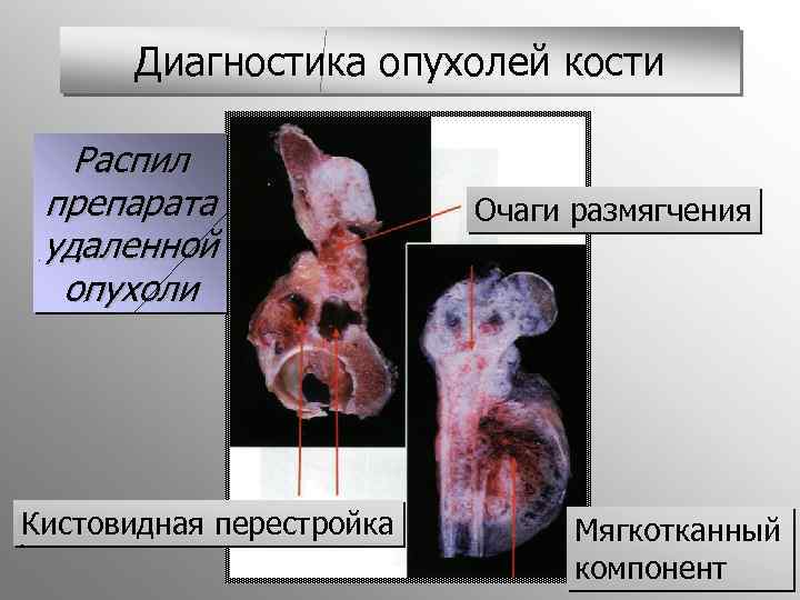 Диагностика опухолей кости Распил препарата удаленной опухоли Кистовидная перестройка Очаги размягчения Мягкотканный компонент 