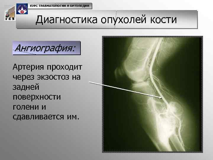 КУРС ТРАВМАТОЛОГИИ И ОРТОПЕДИИ Диагностика опухолей кости Ангиография: Артерия проходит через экзостоз на задней