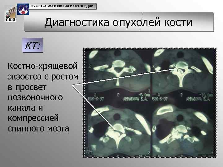 Диагностика опухоли кости