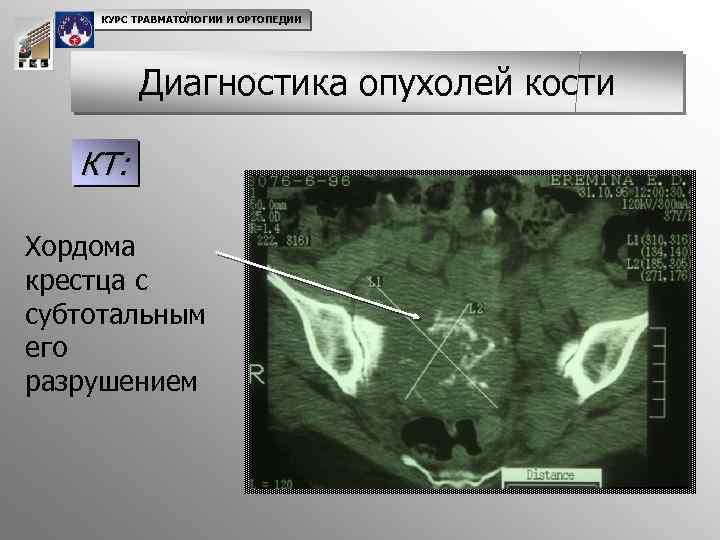 Диагностика опухоли кости. Опухоли костей травматология. Первичные опухоли костей доброкачественные и злокачественные. Опухоли костей травматология презентация. Опухоли костной ткани классификация.