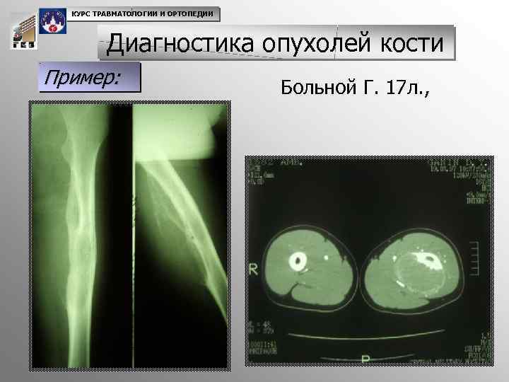 Диагностика опухоли кости. Опухоли костей травматология. Ортопедия диагностика. Ортопедический диагноз.