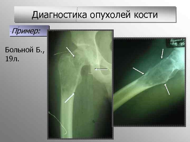 Диагностика костей. Диагностика опухолей кости. Костные опухоли травматология. Методы диагностики опухолей костей. Диагностика опухоли опухоли костей.