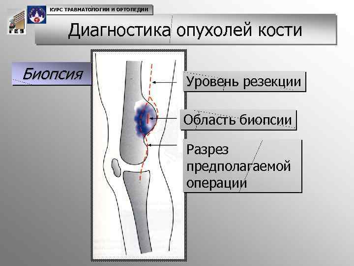 КУРС ТРАВМАТОЛОГИИ И ОРТОПЕДИИ Диагностика опухолей кости Биопсия Уровень резекции Область биопсии Разрез предполагаемой