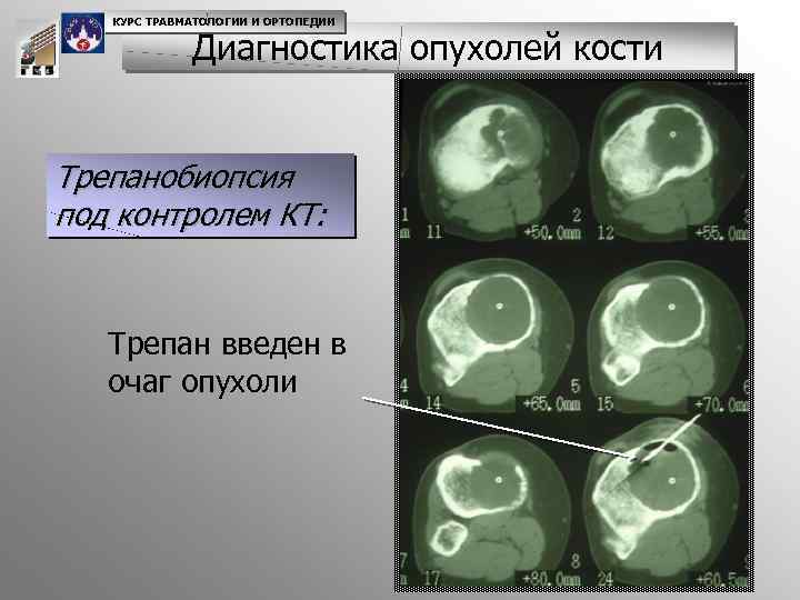 КУРС ТРАВМАТОЛОГИИ И ОРТОПЕДИИ Диагностика опухолей кости Трепанобиопсия под контролем КТ: Трепан введен в