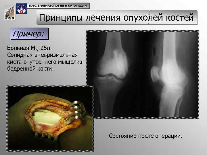 КУРС ТРАВМАТОЛОГИИ И ОРТОПЕДИИ Принципы лечения опухолей костей Пример: Больная М. , 25 л.