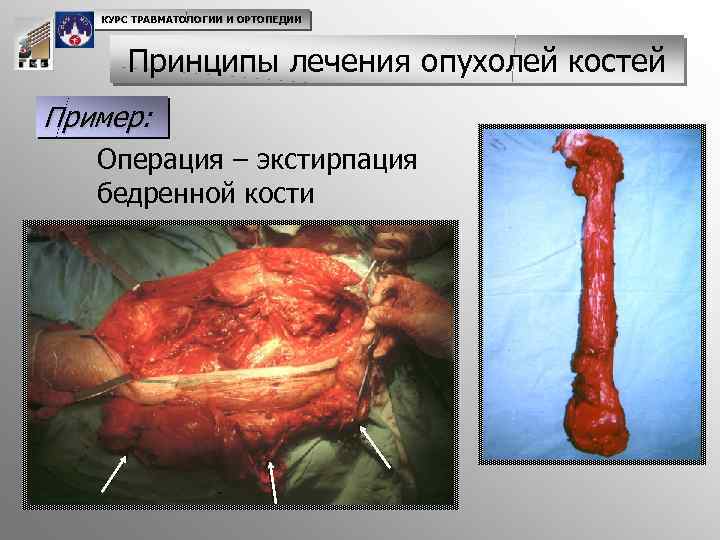 КУРС ТРАВМАТОЛОГИИ И ОРТОПЕДИИ Принципы лечения опухолей костей Пример: Операция – экстирпация бедренной кости