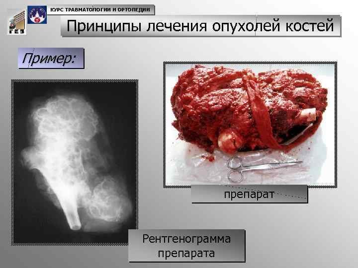 КУРС ТРАВМАТОЛОГИИ И ОРТОПЕДИИ Принципы лечения опухолей костей Пример: препарат Рентгенограмма препарата 