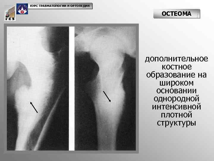 КУРС ТРАВМАТОЛОГИИ И ОРТОПЕДИИ ОСТЕОМА дополнительное костное образование на широком основании однородной интенсивной плотной