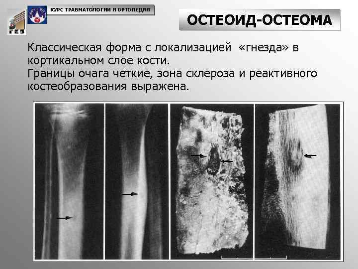 Патологическим костеобразованием напоминающим картину саркомы осложняется