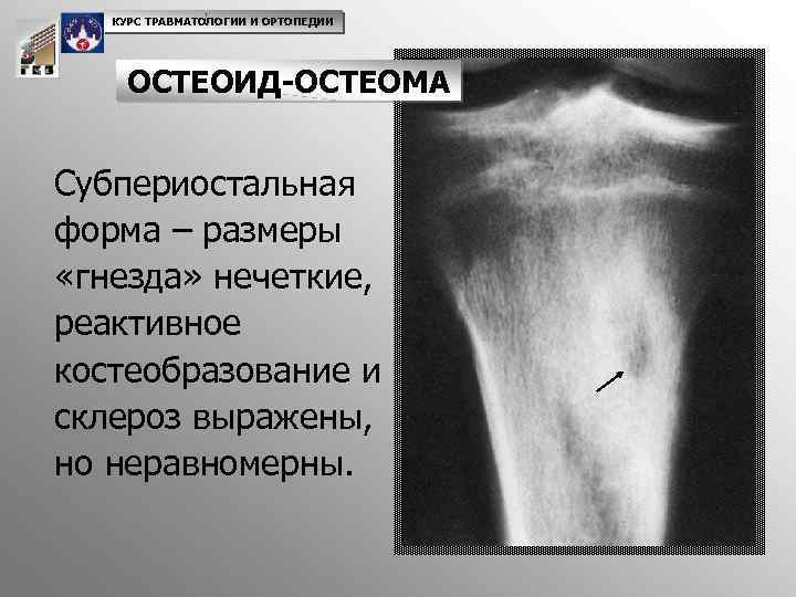 КУРС ТРАВМАТОЛОГИИ И ОРТОПЕДИИ ОСТЕОИД-ОСТЕОМА Субпериостальная форма – размеры «гнезда» нечеткие, реактивное костеобразование и