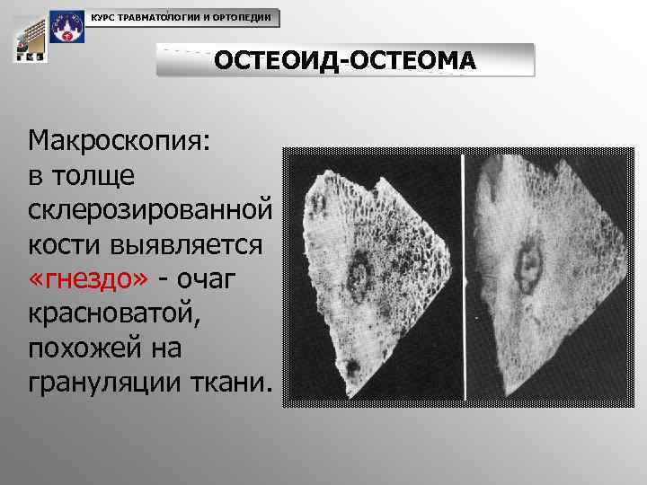 КУРС ТРАВМАТОЛОГИИ И ОРТОПЕДИИ ОСТЕОИД-ОСТЕОМА Макроскопия: в толще склерозированной кости выявляется «гнездо» - очаг