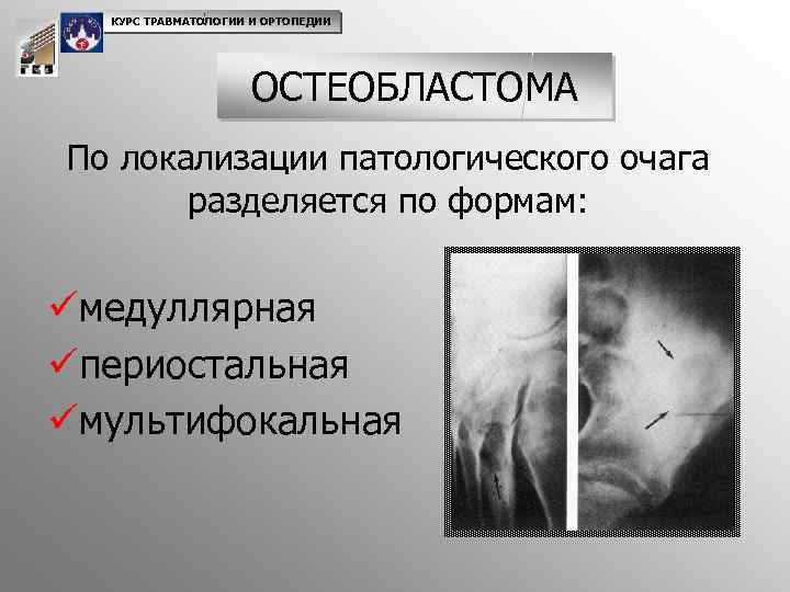 КУРС ТРАВМАТОЛОГИИ И ОРТОПЕДИИ ОСТЕОБЛАСТОМА По локализации патологического очага разделяется по формам: üмедуллярная üпериостальная