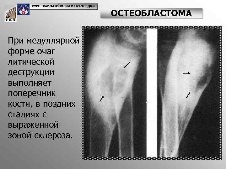 КУРС ТРАВМАТОЛОГИИ И ОРТОПЕДИИ При медуллярной форме очаг литической деструкции выполняет поперечник кости, в