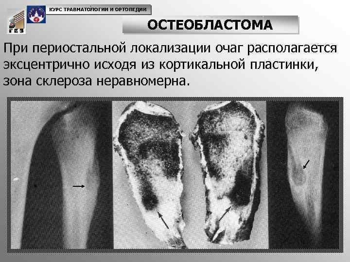 КУРС ТРАВМАТОЛОГИИ И ОРТОПЕДИИ ОСТЕОБЛАСТОМА При периостальной локализации очаг располагается эксцентрично исходя из кортикальной