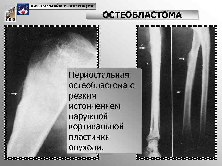 КУРС ТРАВМАТОЛОГИИ И ОРТОПЕДИИ ОСТЕОБЛАСТОМА Периостальная остеобластома с резким истончением наружной кортикальной пластинки опухоли.