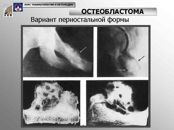 КУРС ТРАВМАТОЛОГИИ И ОРТОПЕДИИ ОСТЕОБЛАСТОМА Вариант периостальной формы 