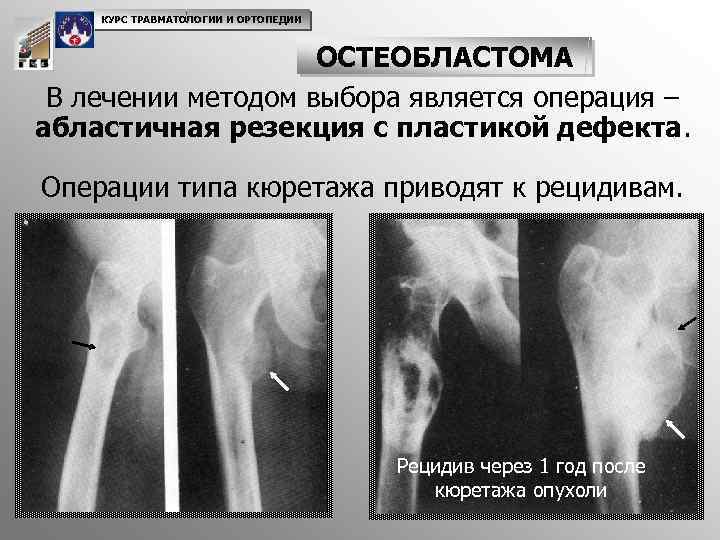 Опухоли костей презентация