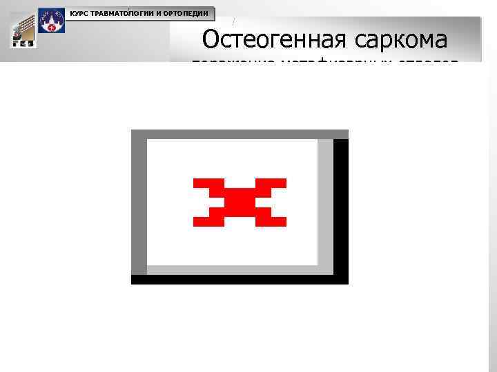 КУРС ТРАВМАТОЛОГИИ И ОРТОПЕДИИ Остеогенная саркома поражение метафизарных отделов длинных трубчатых костей (в%) 