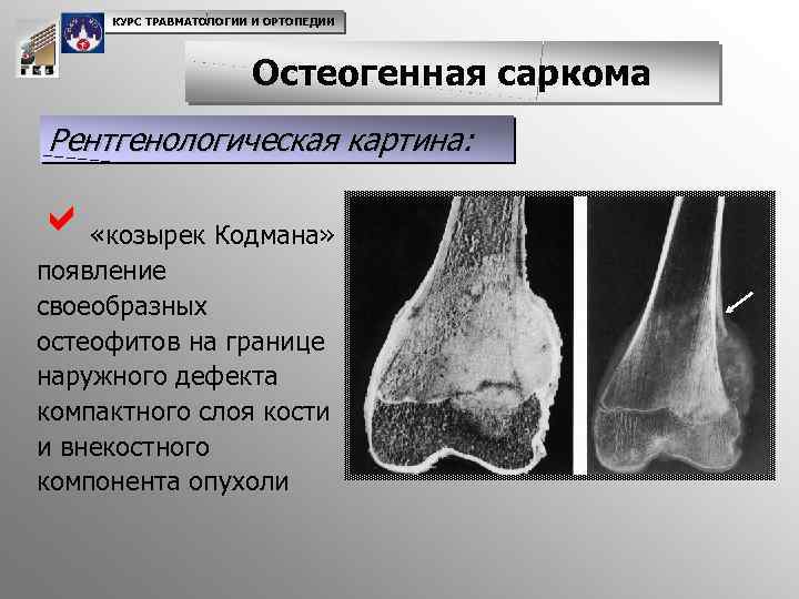 Саркомы костей тест нмо. Остеогенная саркома бедренной кости рентген. Остеогенная остеолитическая саркома. Треугольник Кодмана остеосаркома.