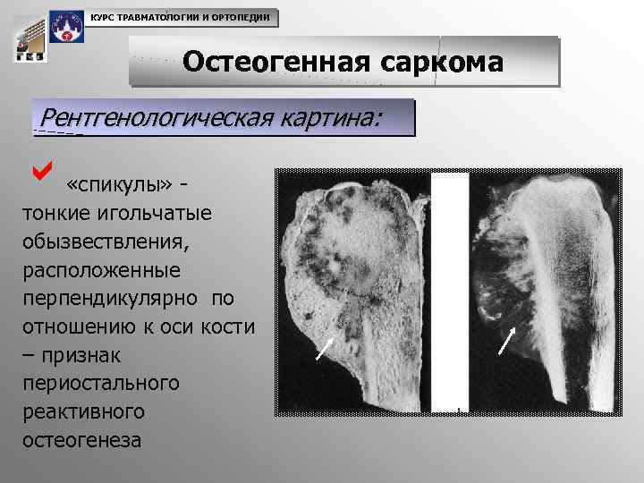 КУРС ТРАВМАТОЛОГИИ И ОРТОПЕДИИ Остеогенная саркома Рентгенологическая картина: a «спикулы» - тонкие игольчатые обызвествления,