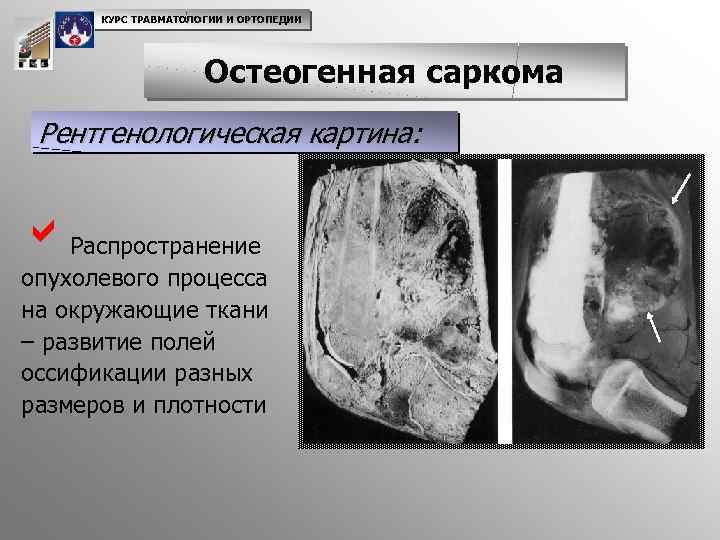 КУРС ТРАВМАТОЛОГИИ И ОРТОПЕДИИ Остеогенная саркома Рентгенологическая картина: a. Распространение опухолевого процесса на окружающие