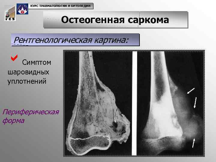 Саркомы костей нмо. Остеосаркома бедренной кости. Остеосаркома коленного сустава рентген.