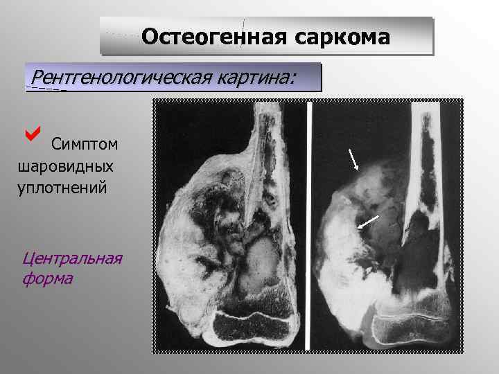 Остеогенная саркома Рентгенологическая картина: a. Симптом шаровидных уплотнений Центральная форма 