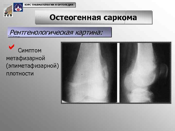 Клиническая картина при остеогенной саркоме в начале заболевания выражается следующими признаками