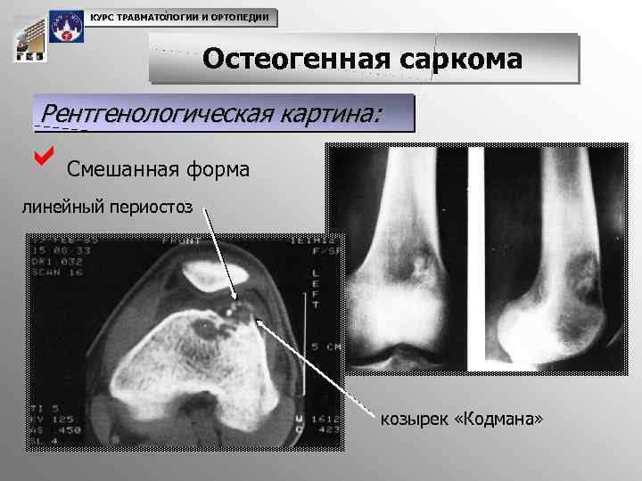 КУРС ТРАВМАТОЛОГИИ И ОРТОПЕДИИ Остеогенная саркома Рентгенологическая картина: a. Смешанная форма линейный периостоз козырек